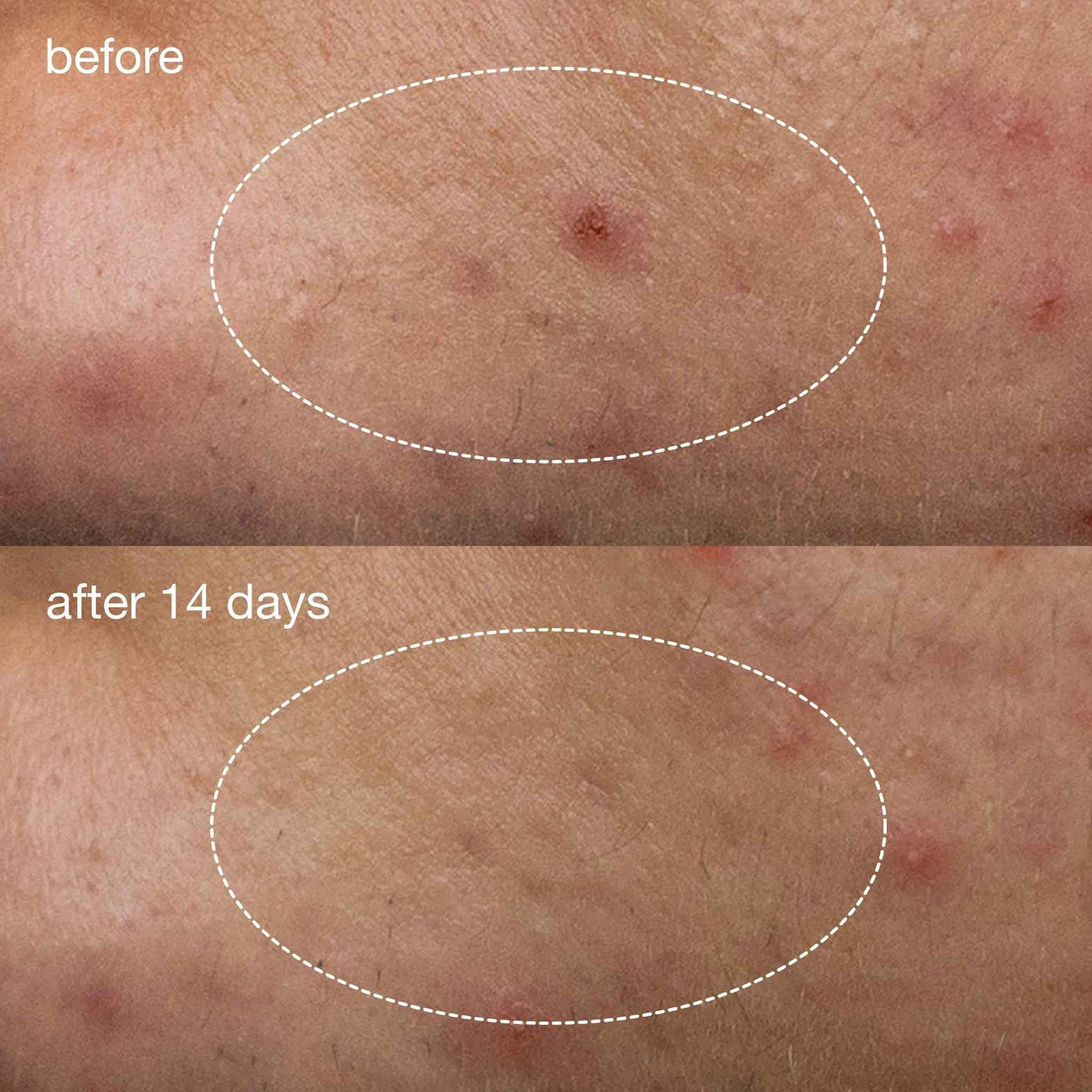 Dermalogica Deep Acne Liquid Patch