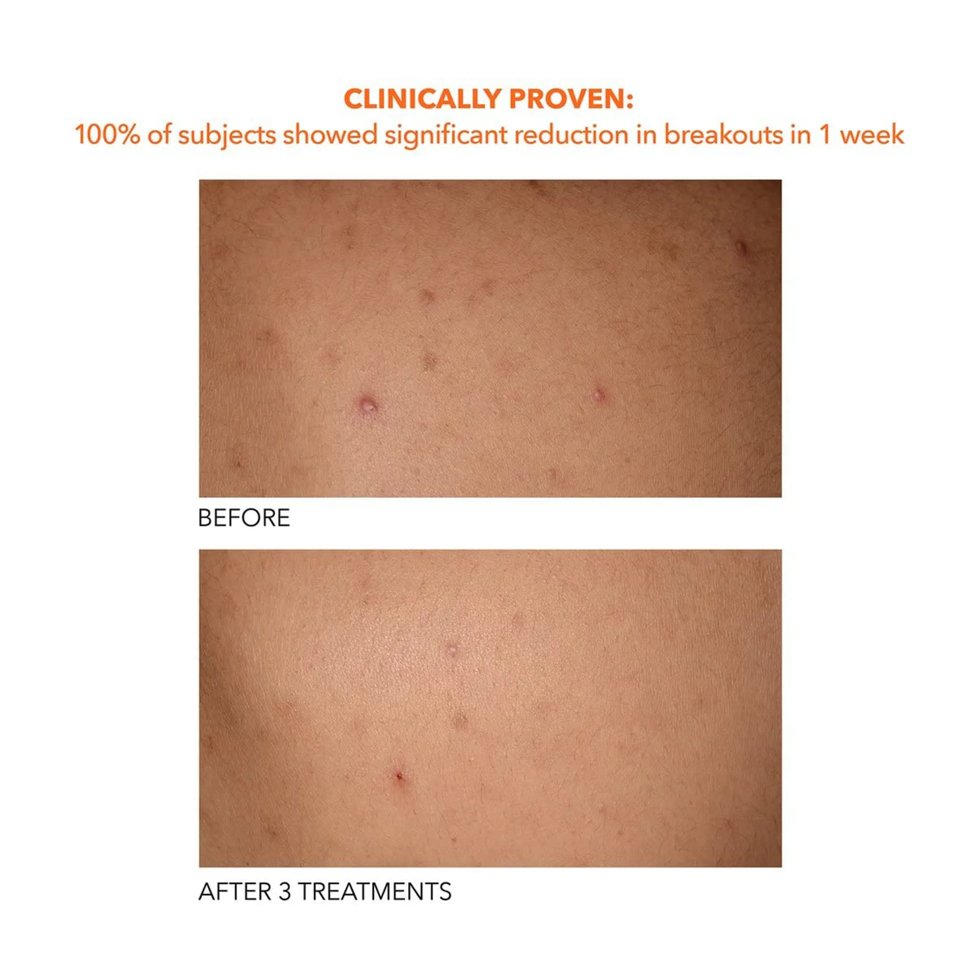 Dr. Dennis Gross Alpha Beta Exfoliating Body Treatment Peel 8 Pk