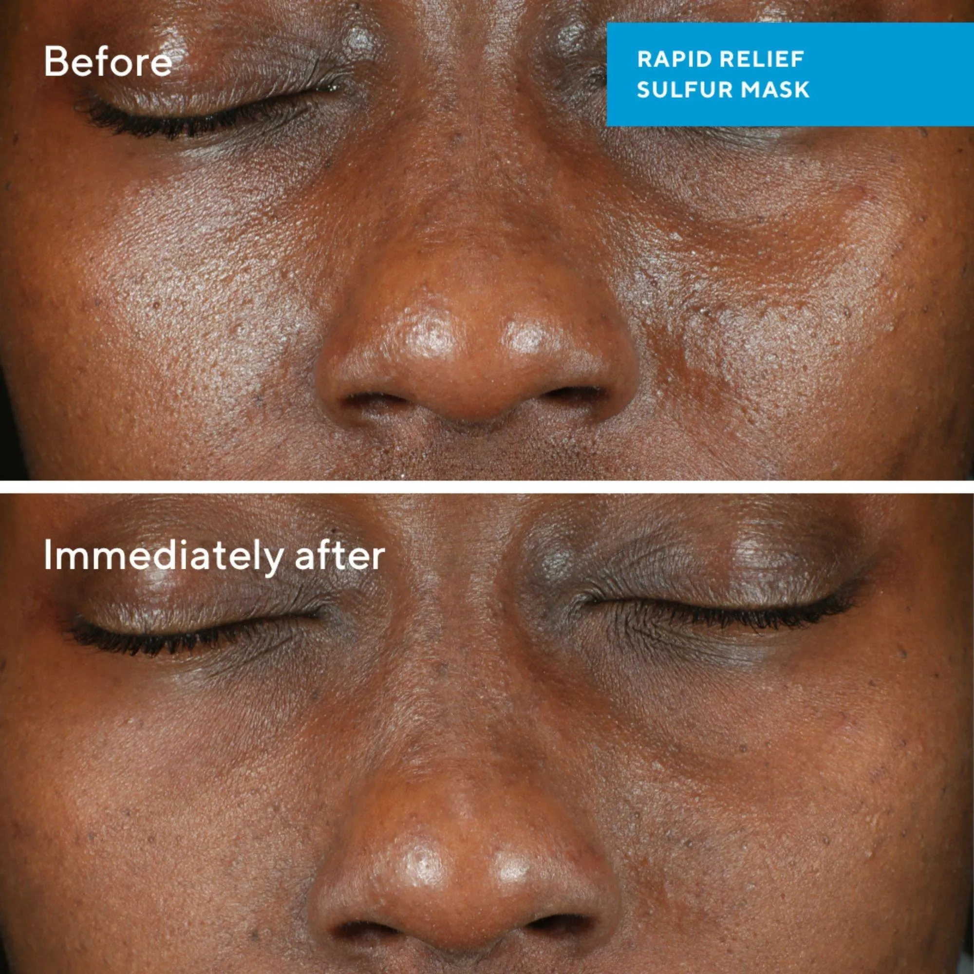 Murad Rapid Relief Acne Sulfur Mask
