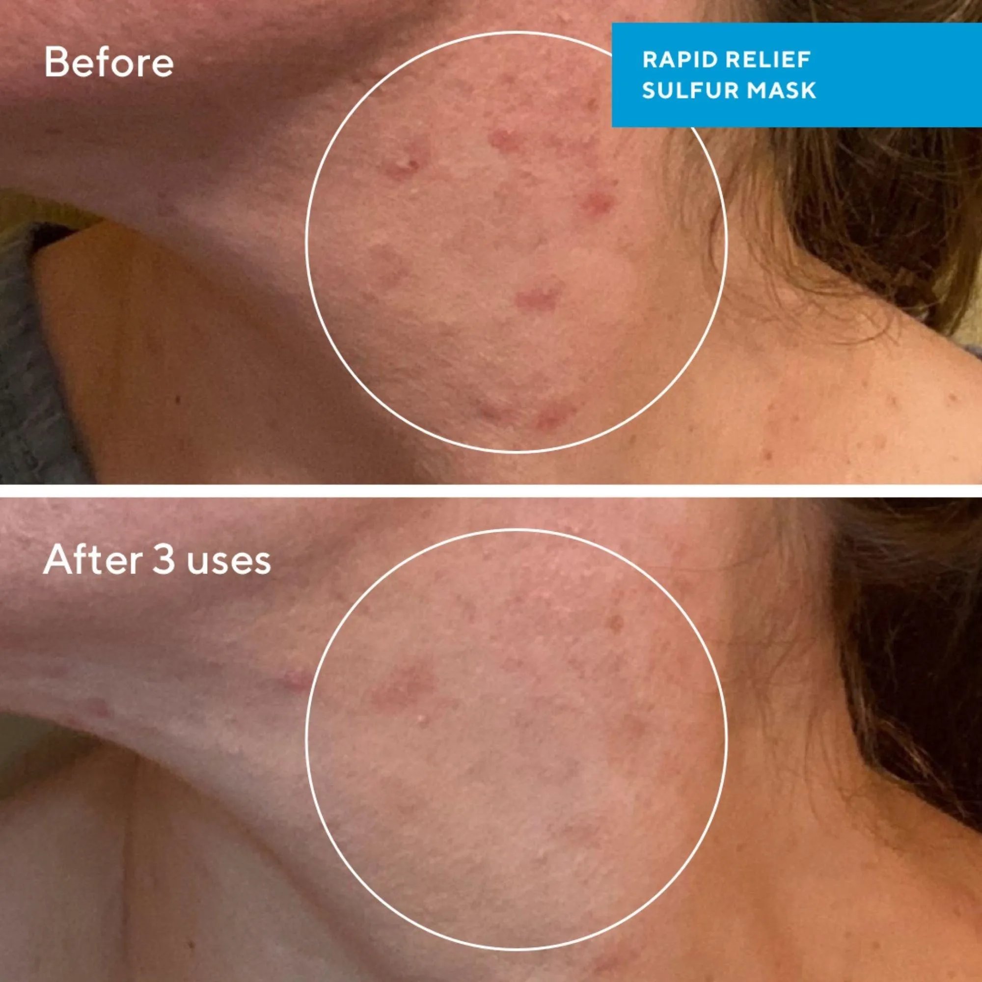 Murad Rapid Relief Acne Sulfur Mask