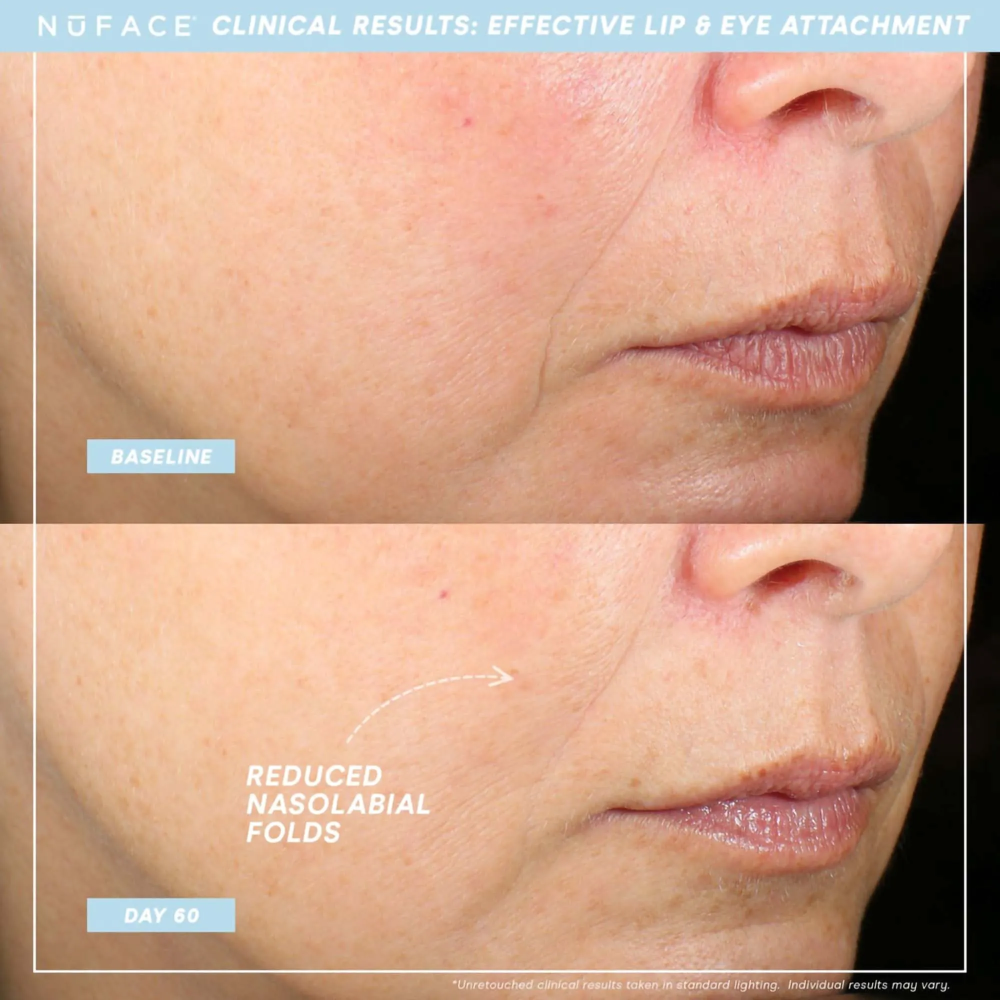 NuFace Trinity  Complete Set - WITH Wrinkle Reducer & Effective Lip Eye Attachments