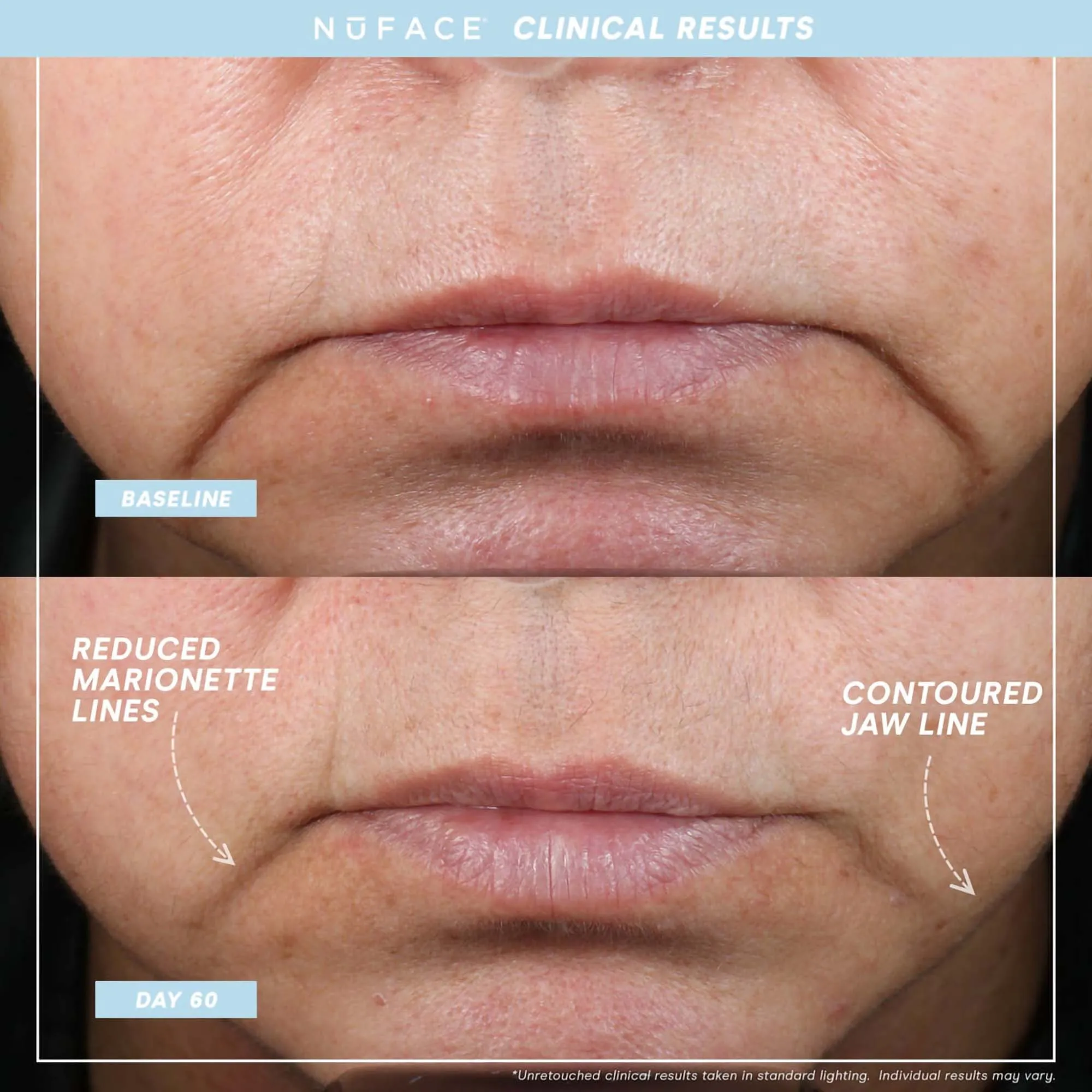 NuFace Trinity  Complete Set - WITH Wrinkle Reducer & Effective Lip Eye Attachments