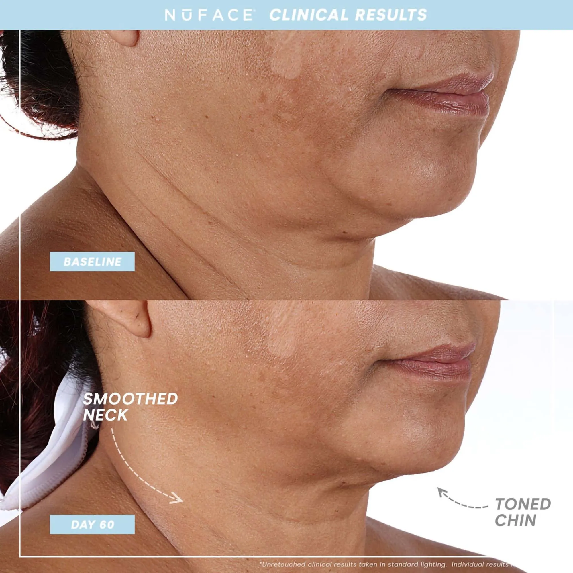 NuFace Trinity  Complete Set - WITH Wrinkle Reducer & Effective Lip Eye Attachments