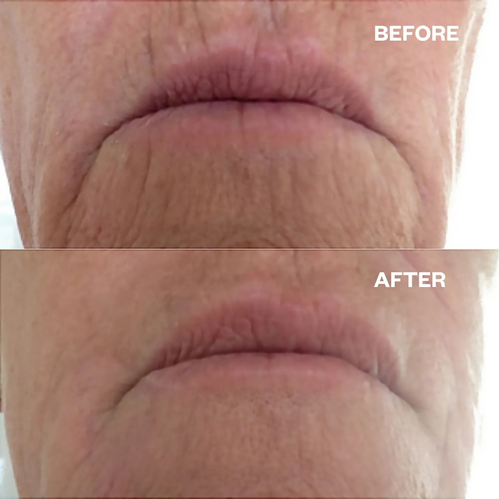 Wrinkles Schminkles Mouth & Lip Wrinkle Patches - 2pc