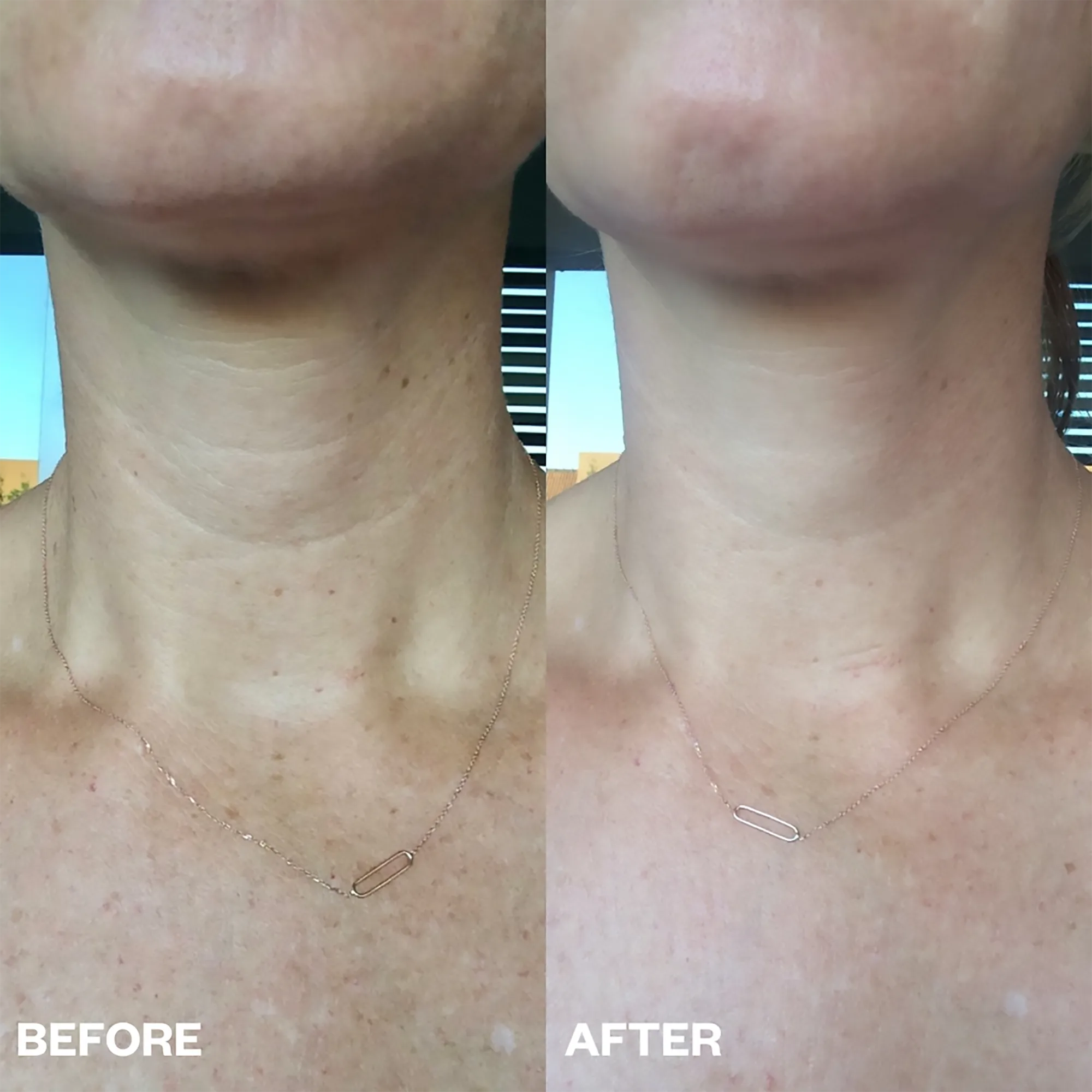 Wrinkles Schminkles Neck Wrinkle Patch